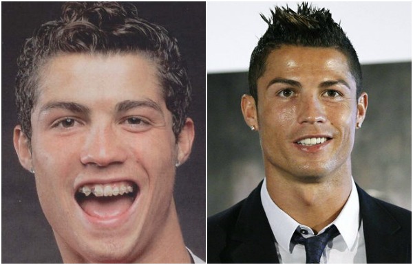 Increíbles antes y después de los dientes de los famosos 